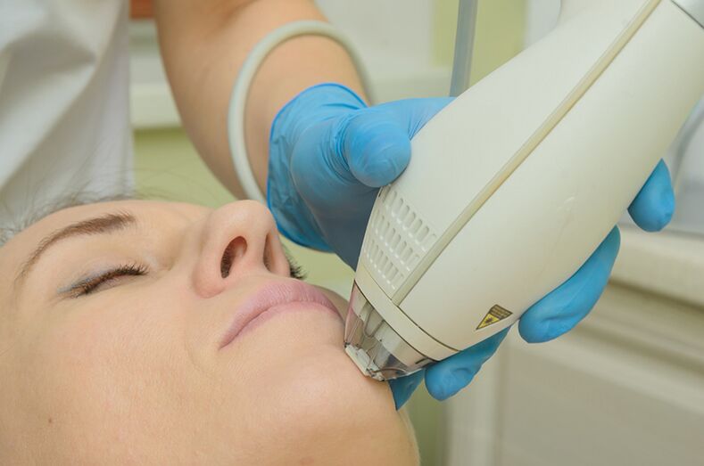 Laser rejuvenation