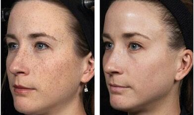 fractional facial rejuvenation before and after photos