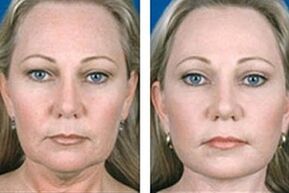 before and after laser facial rejuvenation